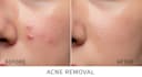 professionally retouch faces, remove pimples and acne scars