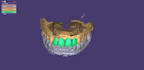 design dental prothesis all on using exocad