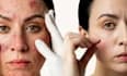 remove acne and spots from your images within 24 hours