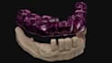design precise surgical guide