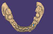 design dental crown and bridge using exocad