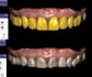 design dental mock ups