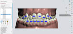 custom aligner treatment plans with 3d clincheck
