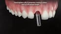 do 3d dental implant animation cosmetic surgical procedure explainer video ads