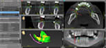 design custom dental implant surgical guide