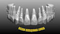 do exocad dental implant design fast and accurately