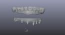 do exocad dental implant design fast and accurately