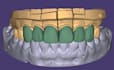 dental cad crown and implant design