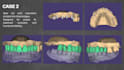 design dental cad crowns, bridges and implants using exocad