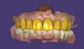 design dental crowns, bridges, veneers, and implants using exocad