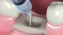create high quality 3d dental animation for implants and bone graft procedures