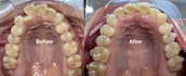 make clear aligner with 3shape