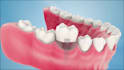 create realistic 3d dental implant and dental procedure animations