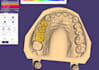 design dental crown and bridge using exocad
