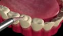 create 3d dental animation, medical animation, 3d dental explainer video