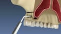 create realistic 3d dental implant animation and dental surgery animation