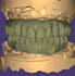 design crowns, bridges, implants, full arch cases using exocad