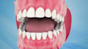 create realistic 3d dental impact and medical animation video