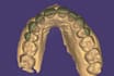 do expert digital dental design on exocade for veneers