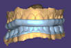 do dental cad design for splints in exocad