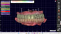 design full arch all on x prosthesis