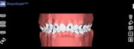 design clear aligner treatment plans