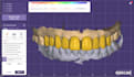 design crowns and bridges using exocad