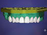 create high quality dental cad desings using exocad