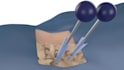 create3d medical device animation spine surgery orthopedic implant visualization