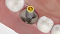 3d dental animation dental implant socket procedure bone graft explainer video