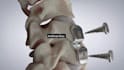 do 3d medical animation cervical disc replacement spine surgery anatomy video
