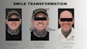 design 3d printed veneer smile makeovers using exocad