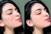 do professional skin retouching and remove acne blemishes