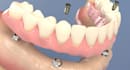 do 3d medical explainer 3d dental implant animation 3d dental surgical procedure
