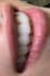 do exocad design , b4d , onyxceph , 3shape