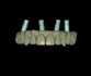 design all on x, all on 4 prosthesis using exocad