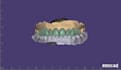 design highly aesthetic crowns and veneers using exocad