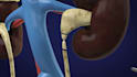 create 3d medical animation surgical procedure urology surgery video