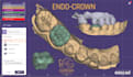 precise crown lengthening surgical guide