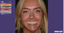 design professional exocad dental cad restorations