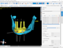 do implant planning ,surgical guide using blue sky and b4d