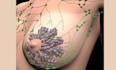 create 3d breast surgical procedure animation, plastic surgery mastopexy video