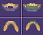 design precise exocad dental crowns, bridges and veneers