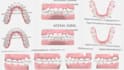 design digital braces setup and indirect bonding trays