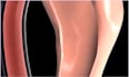 create 3d medical animation surgery anatomical 3d medical device explainer video