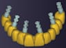 do crown and veneer design