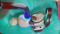 create dental implant animation caries removal and dental device explainer video