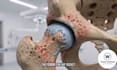 create 3d orthopedic implant, spine and joint surgery animation