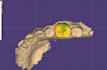 design dental crowns and bridges