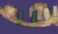 design custom abutments and full arch implant restorations